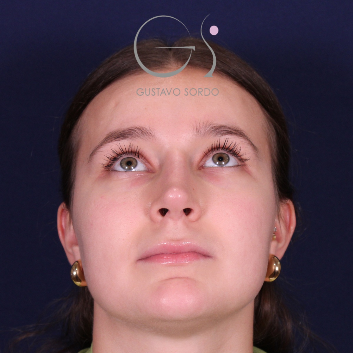 Rinoplastia en nariz aguileña con giba y punta caída, mentón arriba: después de la operación
