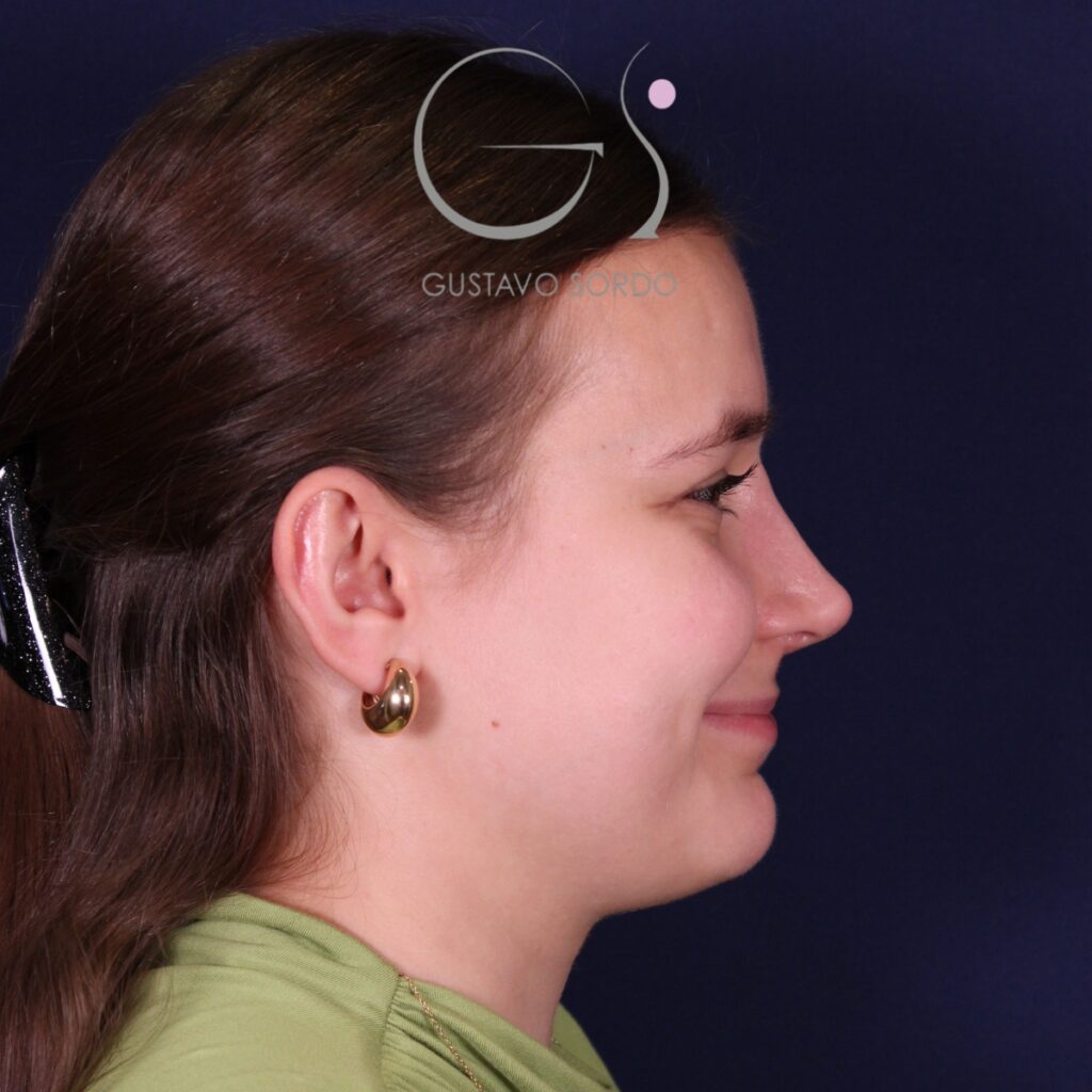 Rinoplastia en nariz aguileña con giba y punta caída, perfil derecho: después de la operación
