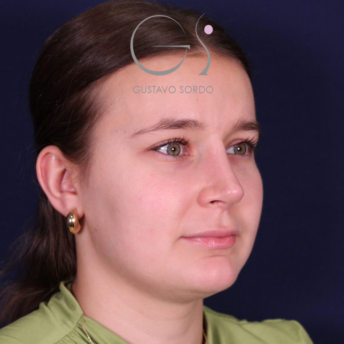 Rinoplastia en nariz aguileña con giba y punta caída, semiperfil derecho: después de la operación