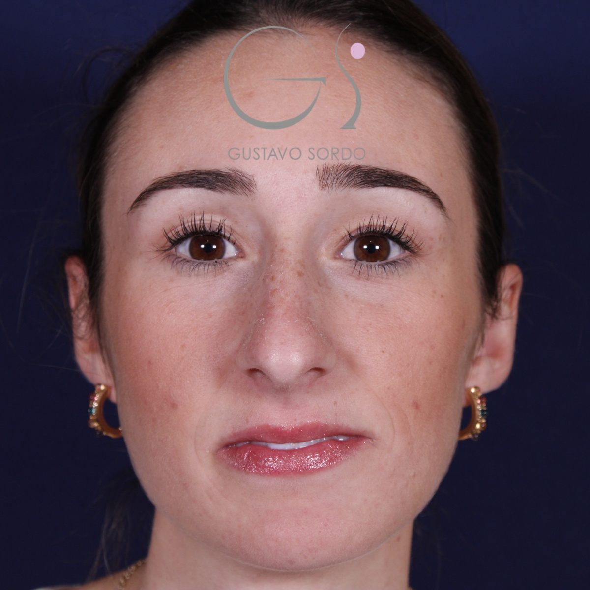 Rinoplastia en mujer con nariz larga, antes de la operación (1)