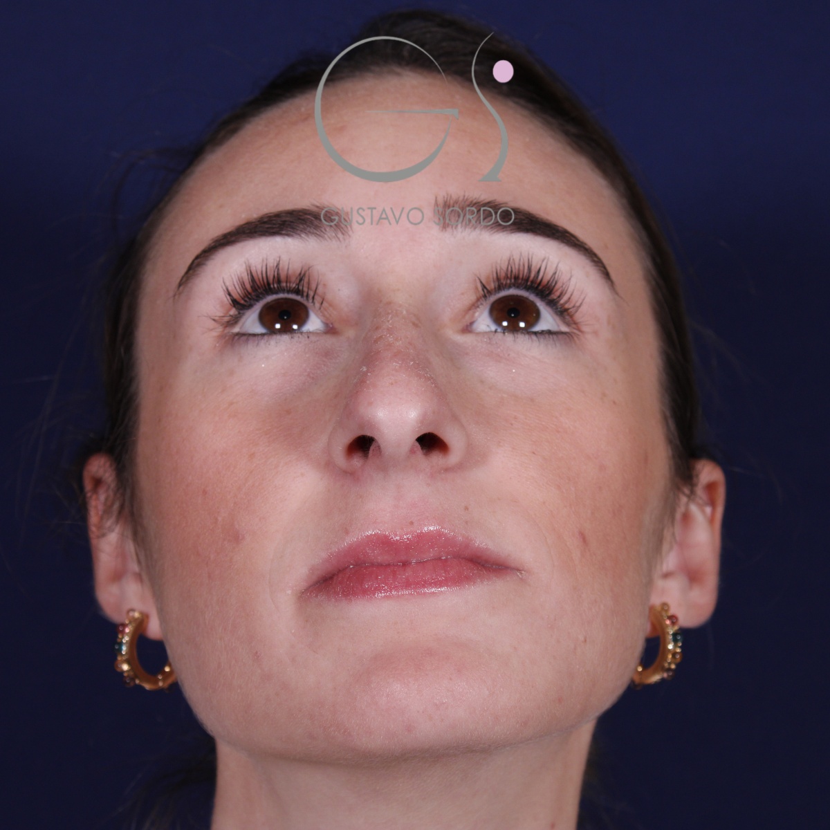 Rinoplastia en mujer con nariz larga, antes de la operación (3)