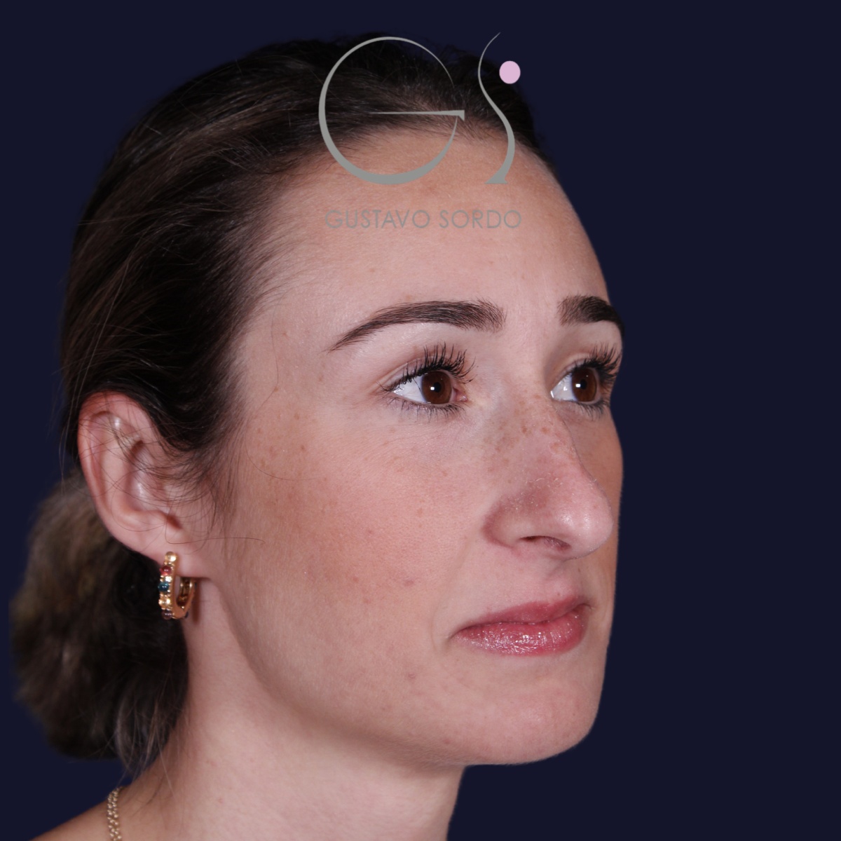 Rinoplastia en mujer con nariz larga, antes de la operación (5)