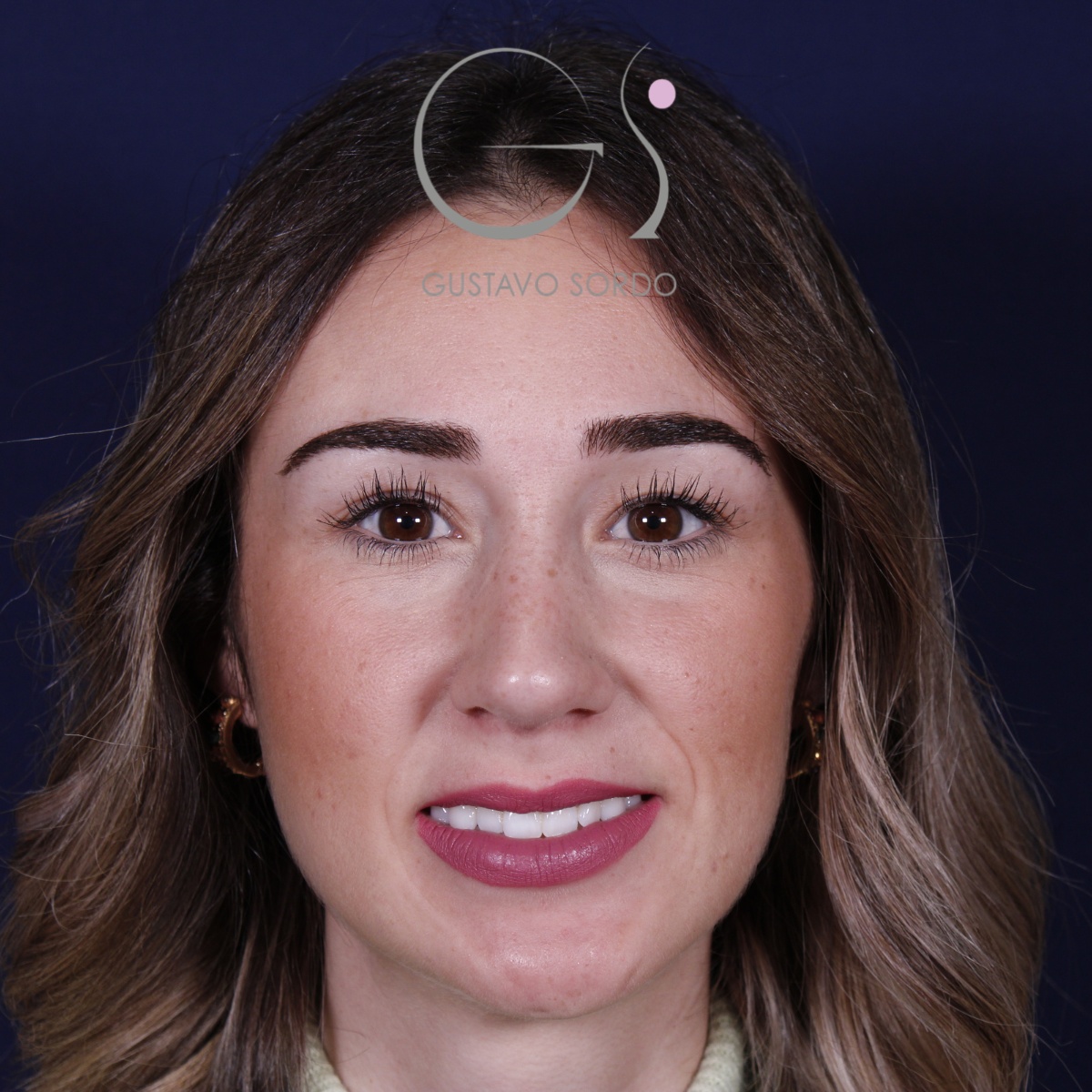 Rinoplastia en mujer con nariz larga, después de la operación (1)