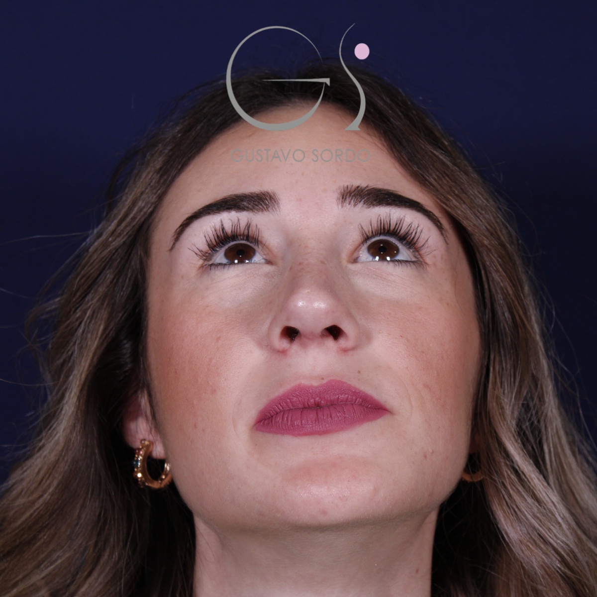 Rinoplastia en mujer con nariz larga, después de la operación (3)