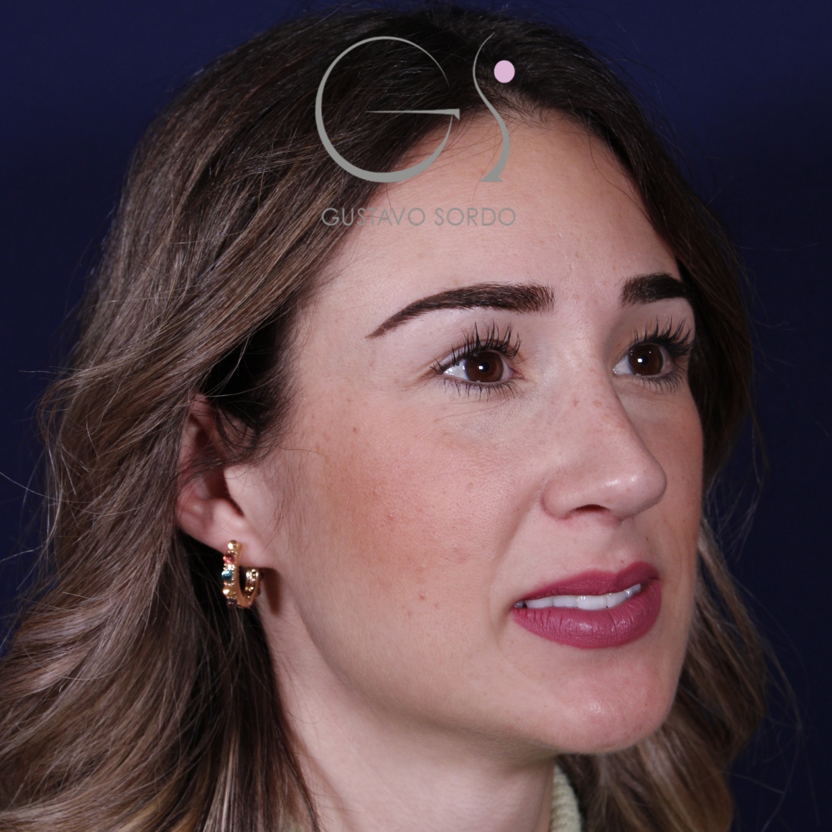 Rinoplastia en mujer con nariz larga, después de la operación (5)