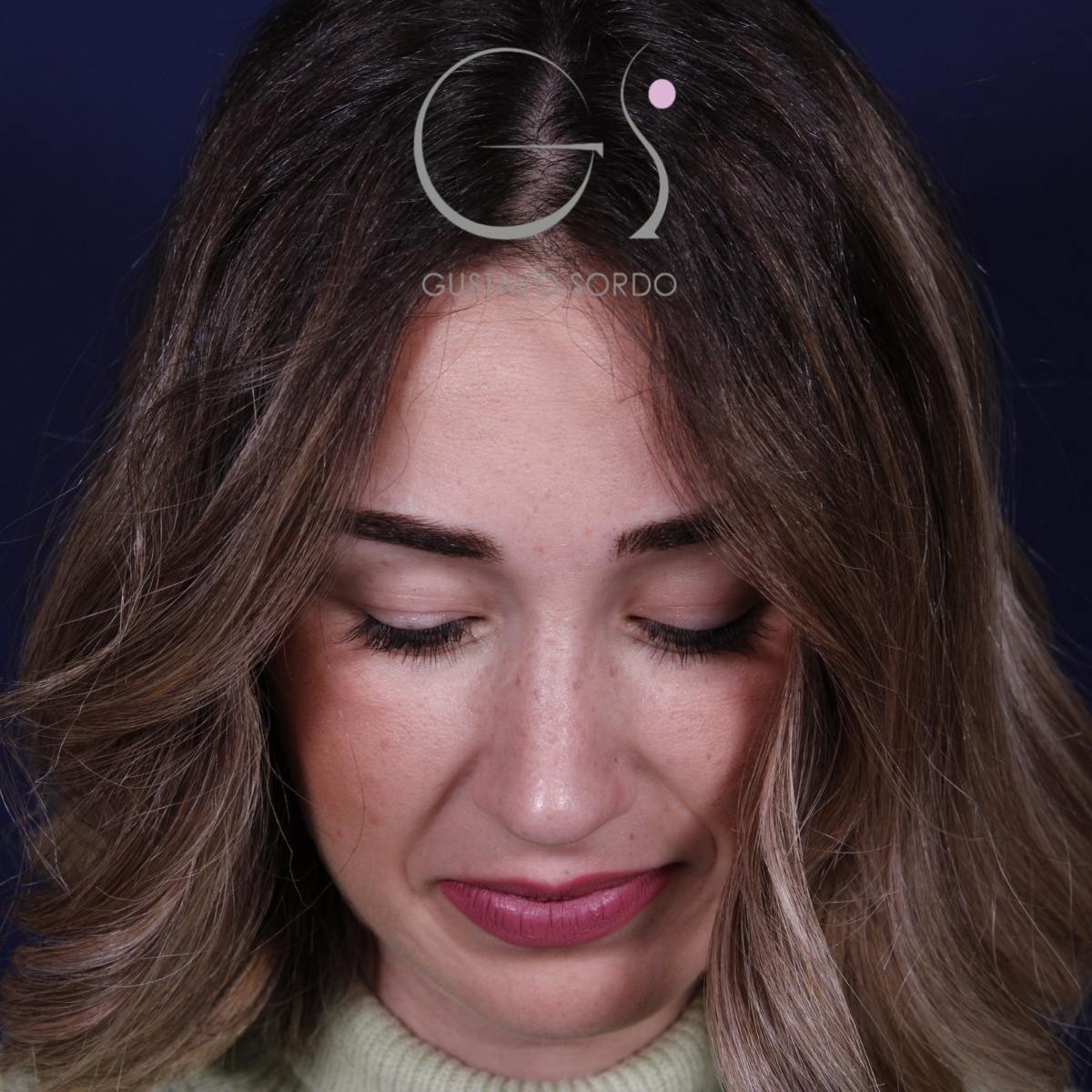 Rinoplastia en mujer con nariz larga, después de la operación (2)