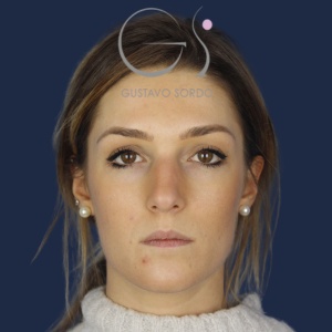 Rinoplastia mujer barbie, antes de la cirugía — caso operado por el Dr. Gustavo Sordo en Madrid (1)