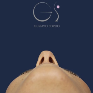 Rinoplastia mujer barbie, antes de la cirugía — caso operado por el Dr. Gustavo Sordo en Madrid (4)