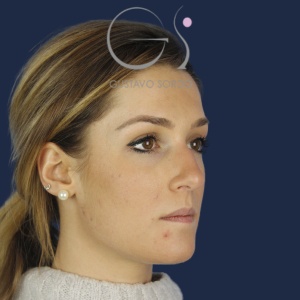Rinoplastia mujer barbie, antes de la cirugía — caso operado por el Dr. Gustavo Sordo en Madrid (5)