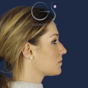 Rinoplastia mujer barbie, antes de la cirugía — caso operado por el Dr. Gustavo Sordo en Madrid (6)