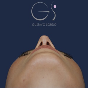 Rinoplastia mujer barbie, resultado tras la cirugía — caso operado por el Dr. Gustavo Sordo en Madrid (4)