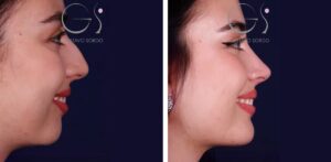 Mentoplastia: antes y después de un caso operado en Madrid