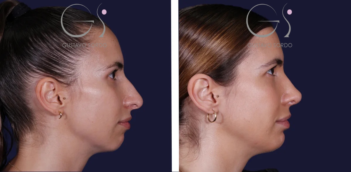 Rinoplastia y mentoplastia: antes y después de un caso operado por el Dr. Gustavo Sordo en Madrid