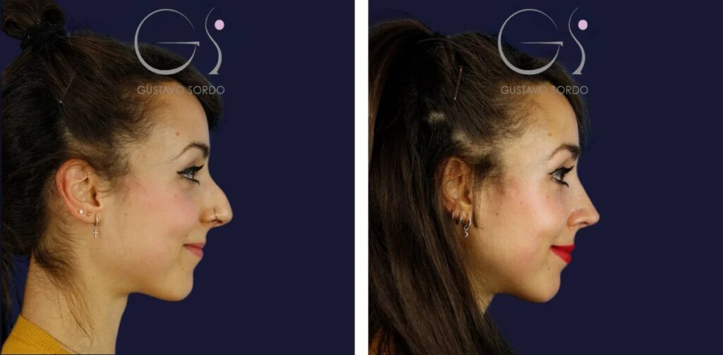 Rhinoplastie — technique ultrasonique&nbsp;: avant et après une intervention réalisée à Madrid