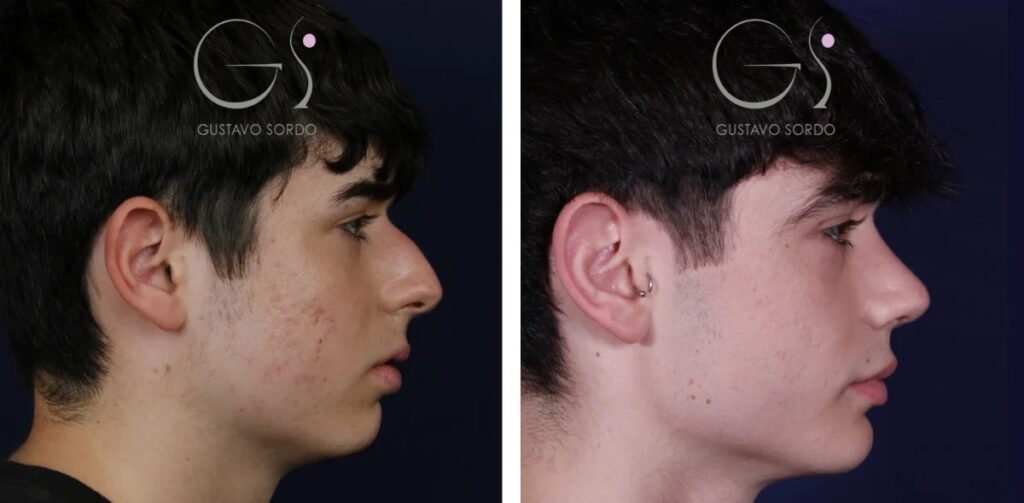Rinoplastia — en hombre: antes y después de un caso operado en Madrid