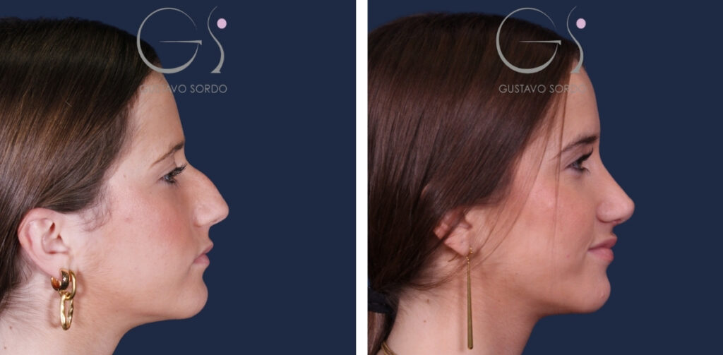 Rhinoplastie — résultat naturel : avant et après une intervention réalisée à Madrid