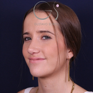 Rinoplastia natural, resultado tras la cirugía — caso operado por el Dr. Gustavo Sordo en Madrid (6)