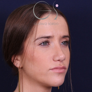 Rinoplastia natural, resultado tras la cirugía — caso operado por el Dr. Gustavo Sordo en Madrid (5)