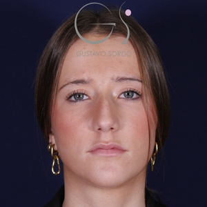 Rinoplastia natural, antes de la cirugía — caso operado por el Dr. Gustavo Sordo en Madrid (1)