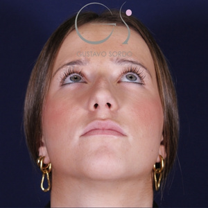 Rinoplastia natural, antes de la cirugía — caso operado por el Dr. Gustavo Sordo en Madrid (3)