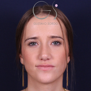 Rinoplastia natural, resultado tras la cirugía — caso operado por el Dr. Gustavo Sordo en Madrid (1)