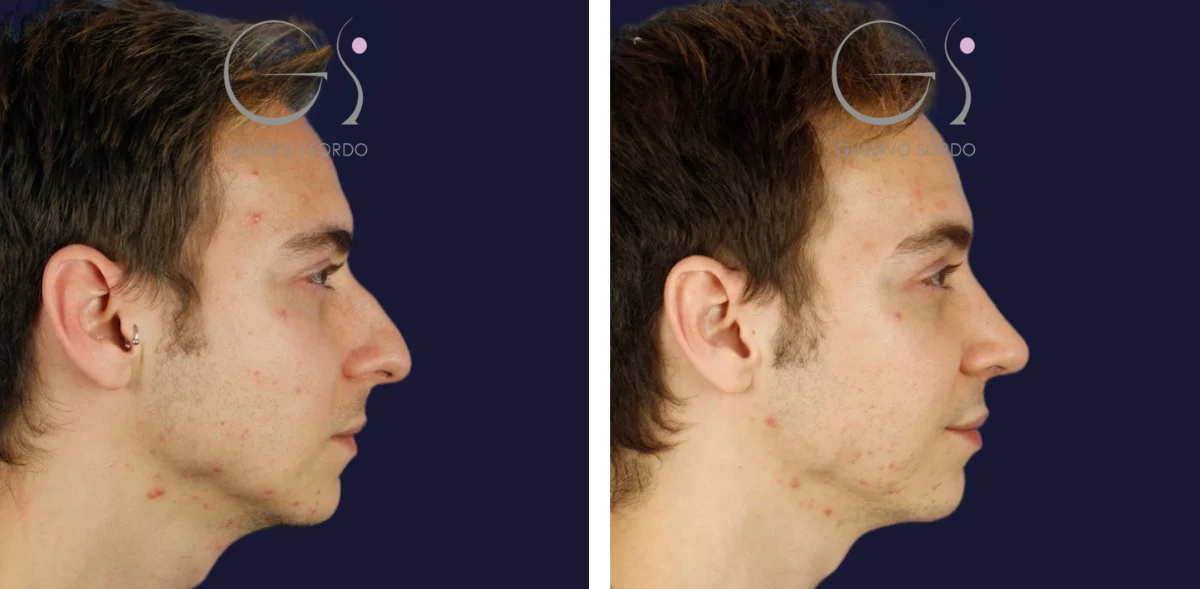 Rinoplastia en hombre con nariz aguileña y piel gruesa: antes y a los siete meses, perfil derecho