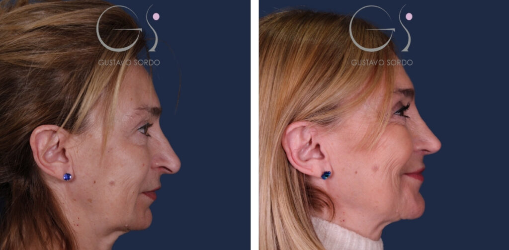 Rhinoplastie — nez long, résultat naturel&nbsp;: avant et après une intervention réalisée à Madrid