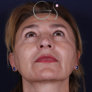 Rinoplastia larga natural, antes de la cirugía — caso operado por el Dr. Gustavo Sordo en Madrid (3)