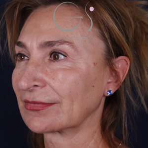 Rinoplastia larga natural, antes de la cirugía — caso operado por el Dr. Gustavo Sordo en Madrid (6)