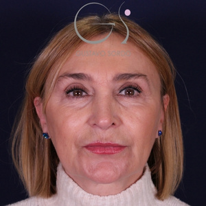 Rinoplastia larga natural, resultado tras la cirugía — caso operado por el Dr. Gustavo Sordo en Madrid (1)