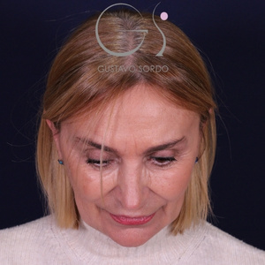 Rinoplastia larga natural, resultado tras la cirugía — caso operado por el Dr. Gustavo Sordo en Madrid (2)