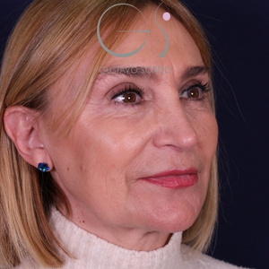 Rinoplastia larga natural, resultado tras la cirugía — caso operado por el Dr. Gustavo Sordo en Madrid (4)