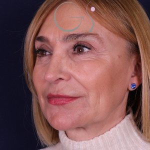 Rinoplastia larga natural, resultado tras la cirugía — caso operado por el Dr. Gustavo Sordo en Madrid (6)