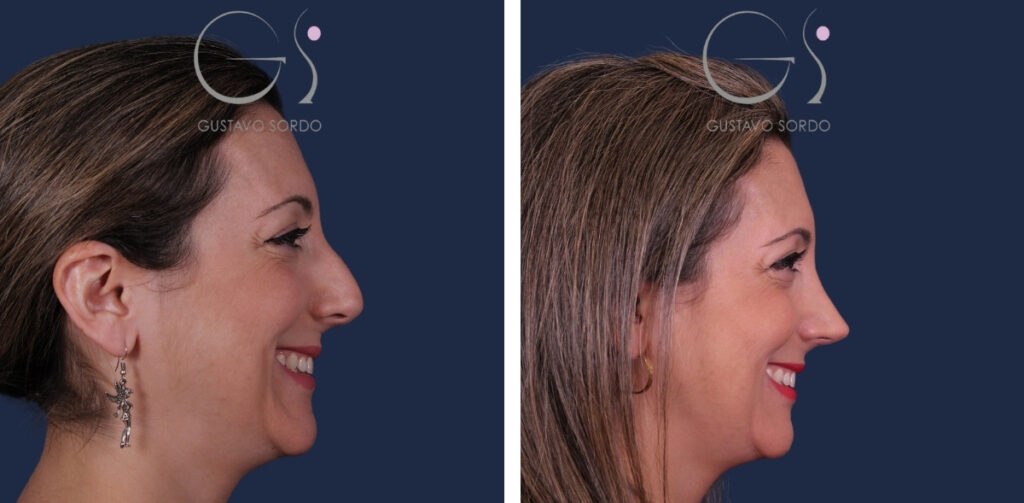 Perfiloplastia — Dr. Gustavo Sordo, cirujano plástico en Madrid (1)