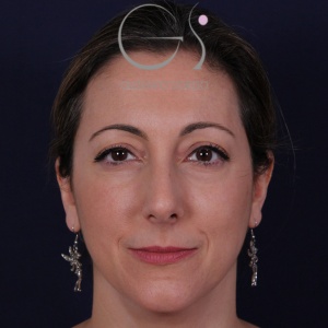 Rinoplastia natural, antes de la cirugía — caso operado por el Dr. Gustavo Sordo en Madrid (1)