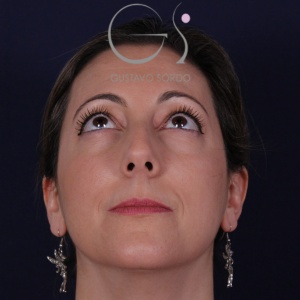 Rinoplastia natural, antes de la cirugía — caso operado por el Dr. Gustavo Sordo en Madrid (2)