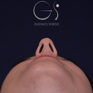 Rinoplastia natural, antes de la cirugía — caso operado por el Dr. Gustavo Sordo en Madrid (4)