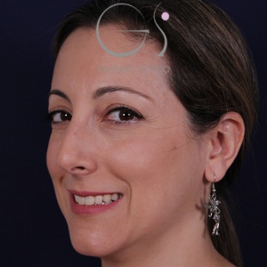 Rinoplastia natural, antes de la cirugía — caso operado por el Dr. Gustavo Sordo en Madrid (6)