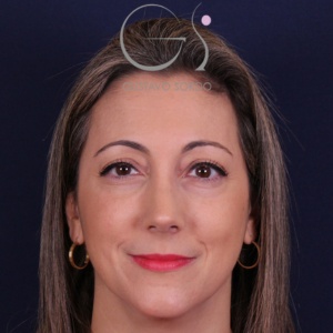 Rinoplastia natural, resultado tras la cirugía — caso operado por el Dr. Gustavo Sordo en Madrid (1)