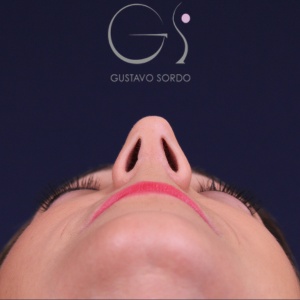 Rinoplastia natural, resultado tras la cirugía — caso operado por el Dr. Gustavo Sordo en Madrid (4)