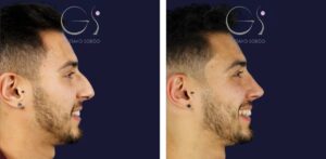 Rinoplastia — técnica ultrasónica, tabique desviado: antes y después de un caso operado en Madrid