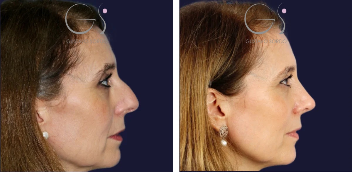 Rinoplastia: antes y después de un caso operado en Madrid