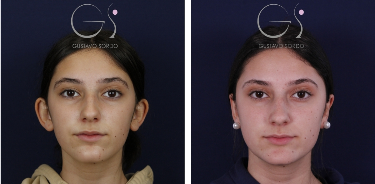 Otoplastia — antes y después — Dr. Gustavo Sordo, cirujano plástico en Madrid