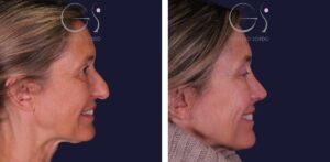 Rinoplastia — nariz larga: antes y después de un caso operado en Madrid
