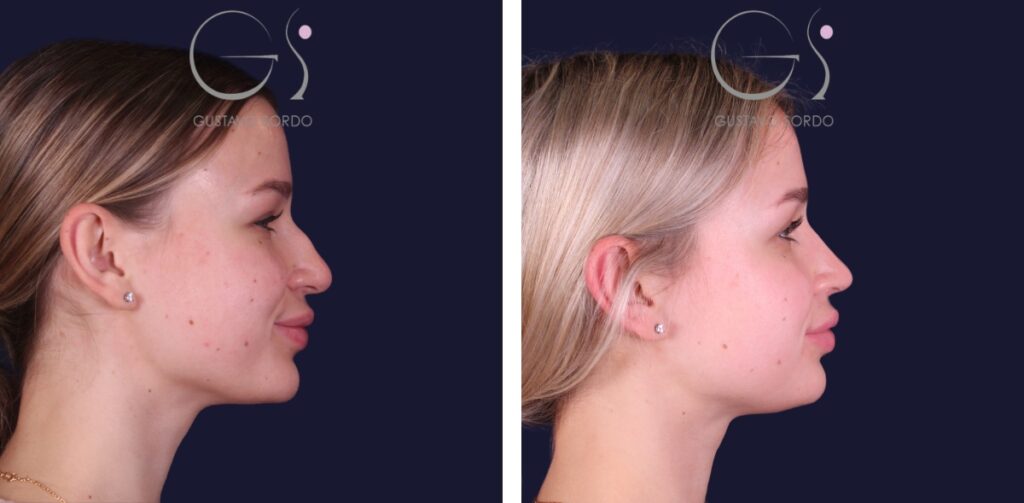 Rhinoplastie — nez droit, résultat naturel&nbsp;: avant et après une intervention réalisée à Madrid