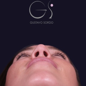 Rinoplastia nariz aguileña, resultado tras la cirugía — caso operado por el Dr. Gustavo Sordo en Madrid (6)