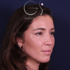 Rinoplastia nariz aguileña, resultado tras la cirugía — caso operado por el Dr. Gustavo Sordo en Madrid (4)