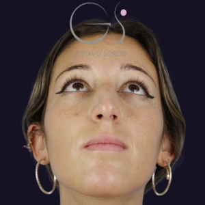 Rinoplastia nariz aguileña, antes de la cirugía — caso operado por el Dr. Gustavo Sordo en Madrid (3)