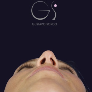 Rinoplastia nariz aguileña, antes de la cirugía — caso operado por el Dr. Gustavo Sordo en Madrid (6)