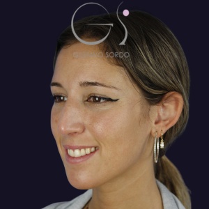 Rinoplastia nariz aguileña, antes de la cirugía — caso operado por el Dr. Gustavo Sordo en Madrid (5)